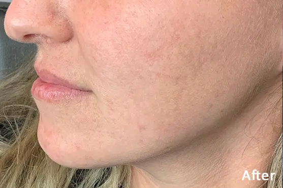 Lumecca IPL after treatment showing improvement in cheek pigmentation and uneven skin tone