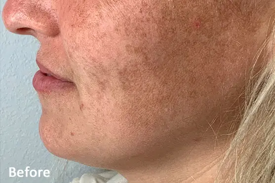 Lumecca IPL before treatment showing cheek pigmentation and uneven skin tone