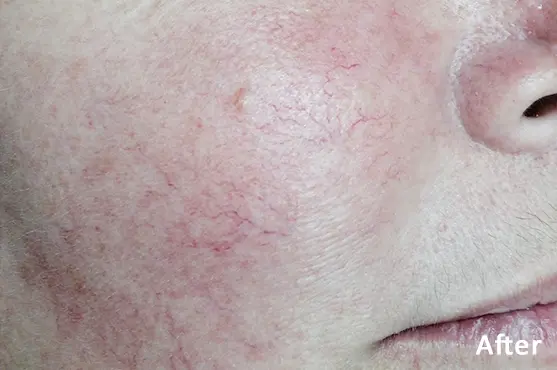Lumecca IPL after treatment showing visible improvement in facial pigmentation