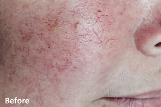 Lumecca IPL before treatment showing facial pigmentation before treatment