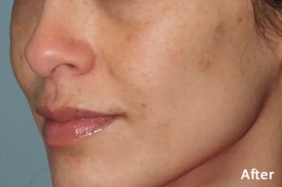 Lumecca IPL after treatment showing improvement in facial freckles and pigmentation