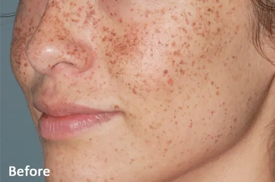 Lumecca IPL before treatment showing visible facial freckles and pigmentation